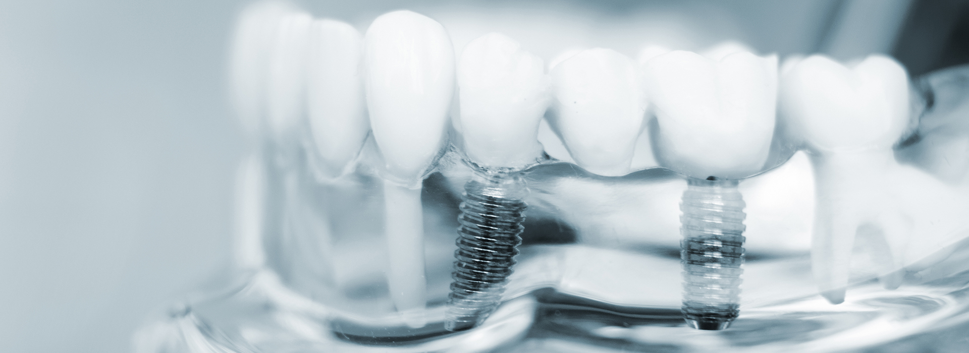 Great Neck Dental Arts | Implant Dentistry, Pediatric Dentistry and iTero Element reg  5D scanner